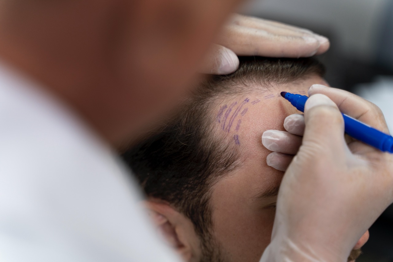 Realistic Expectations: Hair Growth Timeline After FUE in Turkey