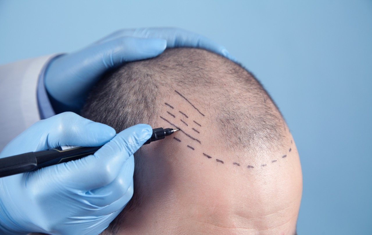 How Long Does It Take for a Hair Transplant to Show Results?