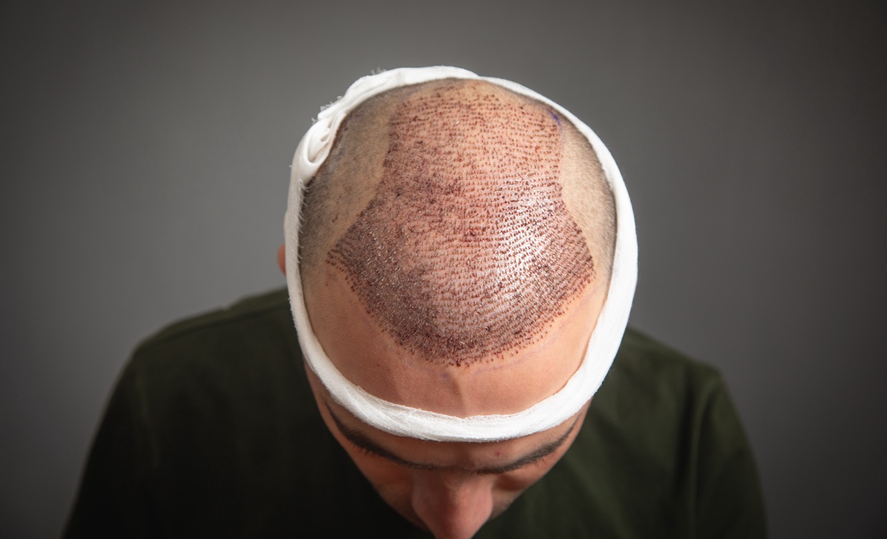 Minimizing Scarring After a Hair Transplant: Techniques and Care