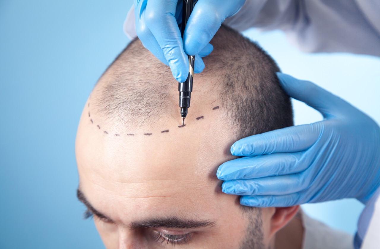DHI vs. FUE Hair Transplant: Which is Best for You?