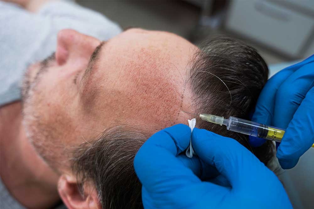 Choosing Between Beard, Mustache, and Hair Transplant: Turkey’s Best Options