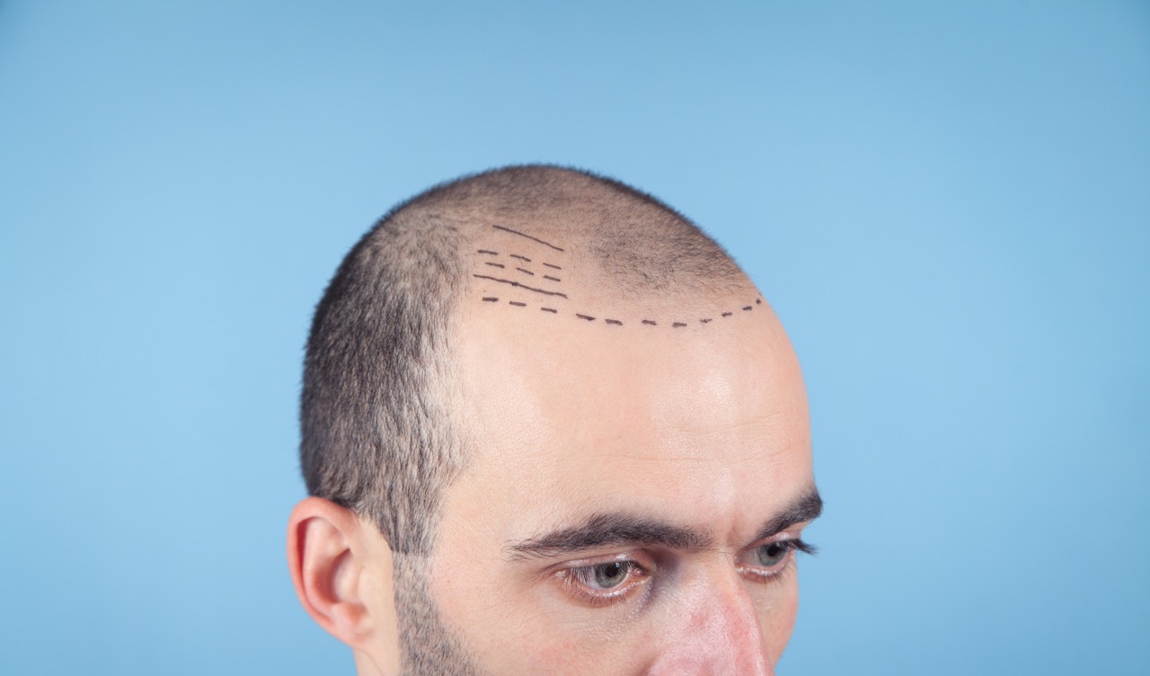 How to Choose the Right Hair Transplant Clinic in Turkey