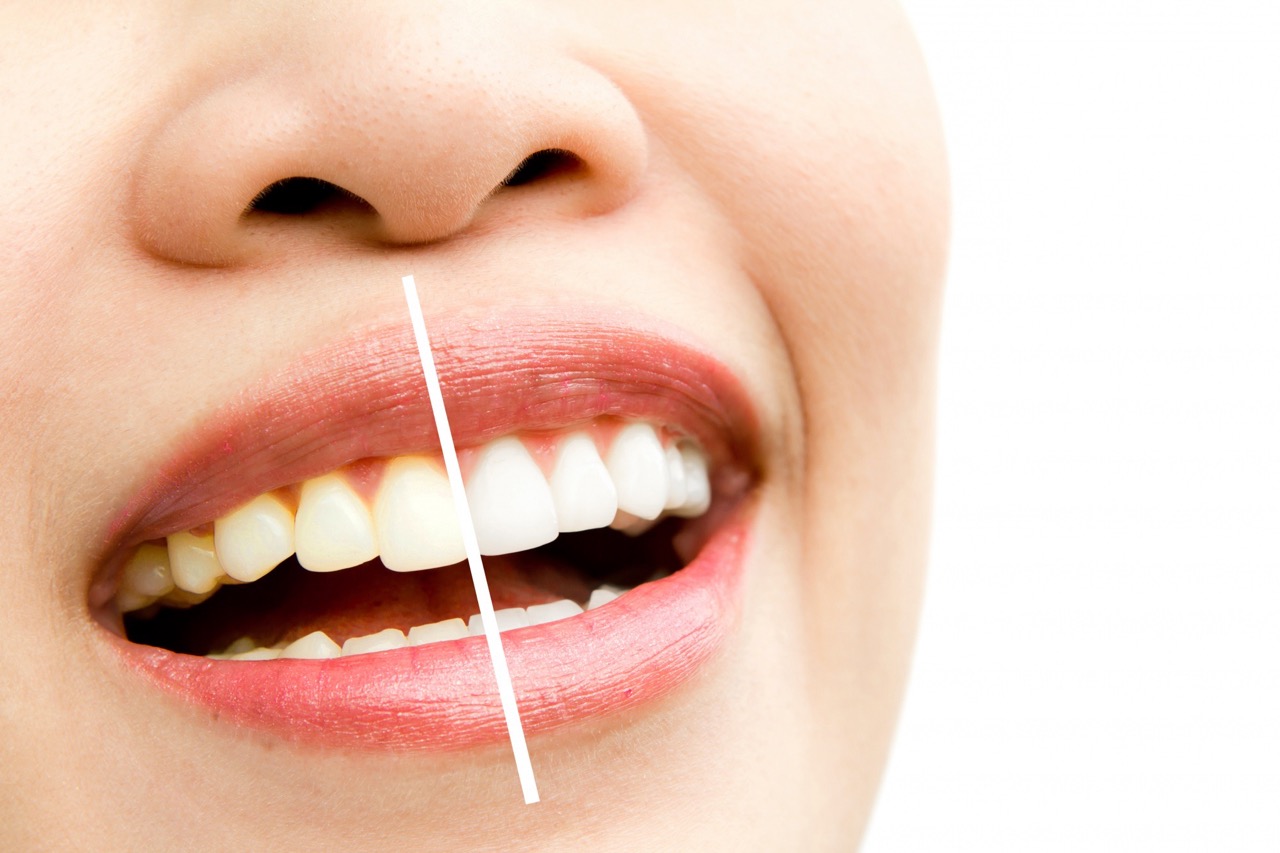 What Are the Benefits of Getting Teeth Whitening in Turkey?